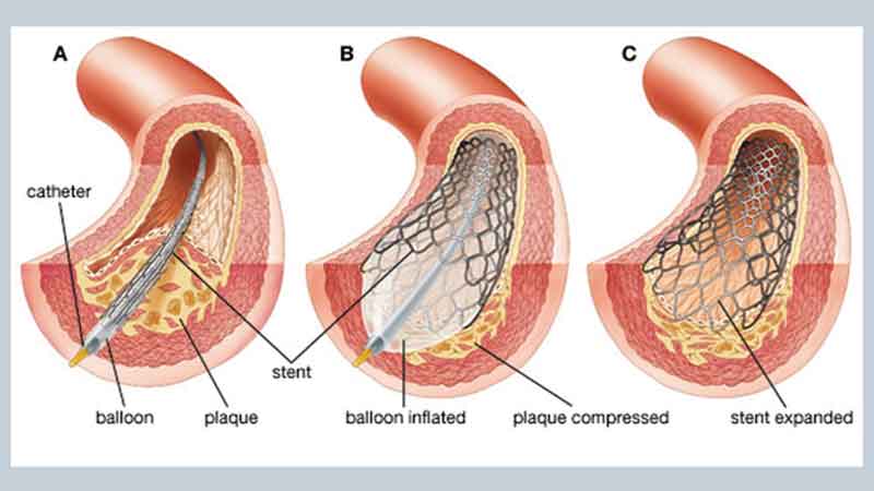 Cardiac-catheterisation
