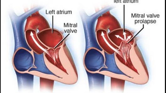 Mitral-Valve-Regurgitation