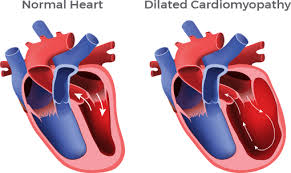 dilated-cardiomyopathy