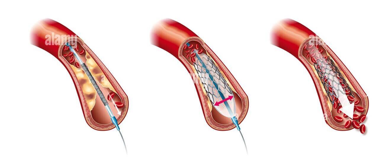 Angioplasty and stenting