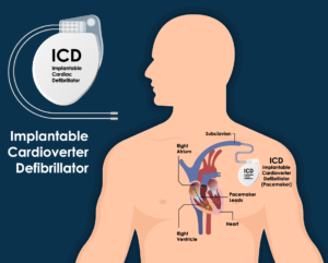 Pacemaker and ICD