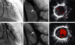 ivus in angioplasty