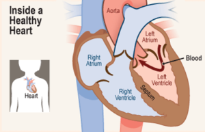 Atrial Septal Defects