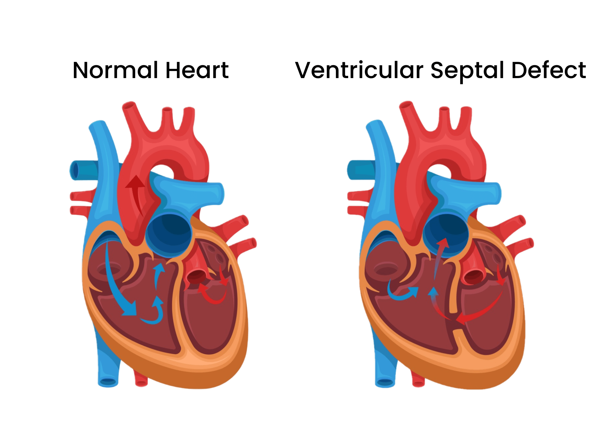 Ventricular Septal Defects (VSD)