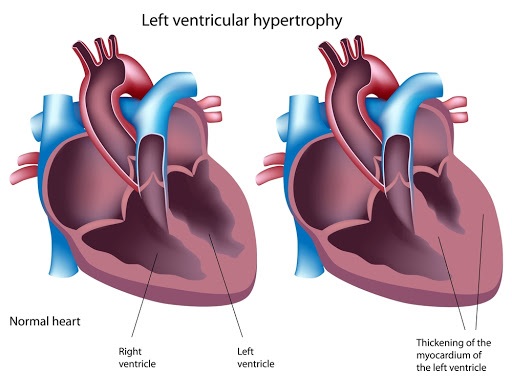 Hypertrophic-cardiomyopathy