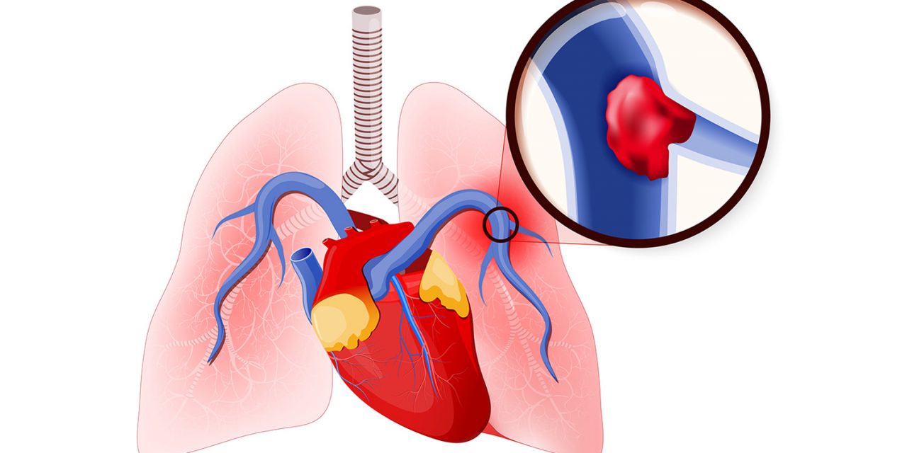 What Is Pulmonary Embolism â€“ Symptoms, Treatment And Recovery | Dr Atul  Kasliwal's Blog â€“ Cardiology, Heart Doctor, Cardiac Specialist