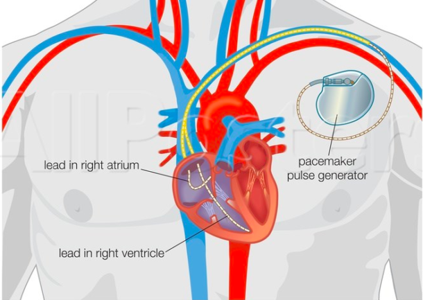 Pacemaker